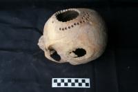 New Bone Growth at the Trepanation Site on the Side of the Head