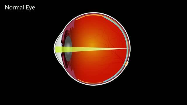 How Multifocal Lenses Control Myopia