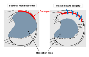 Comparing surgeries for repairing a torn meniscus in young patients