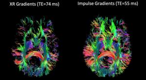 NexGen 7T brain scanner allows for detailed tractography