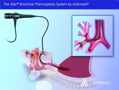 Bronchial Thermoplasty