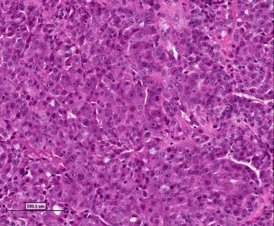 Aggressive, Metastatic Breast Tumor, Pre-Treatment