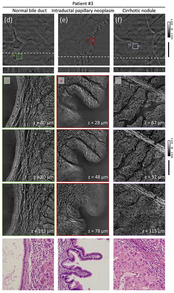 Volumetric histopathology of unlabeled 100-&mu;m-thick pancreas tissue sample.