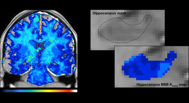 Blood-Brain Barrier Breakdown