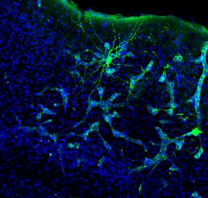 1.	Metastasis in mouse brain