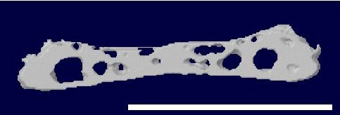 Ossified Vertebral Endplate