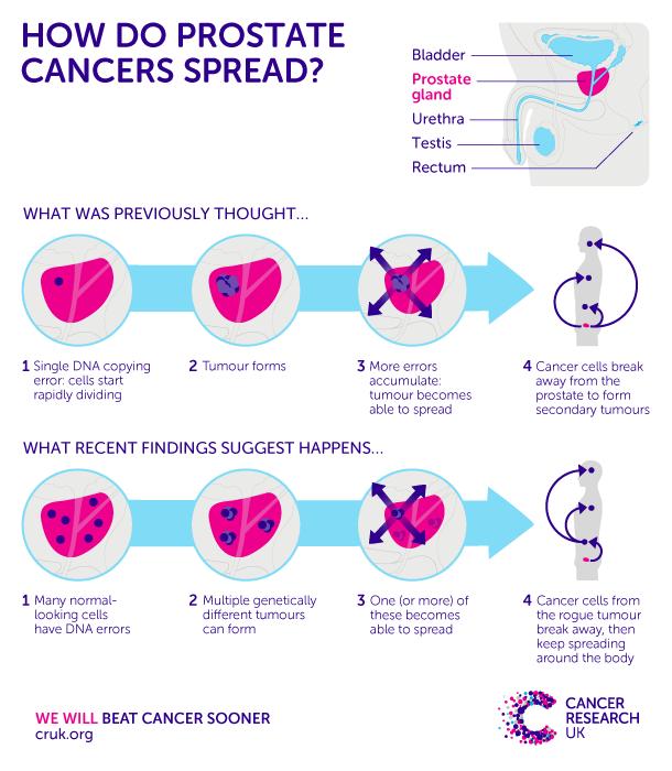Infographic of How Prostate Cancer Spreads