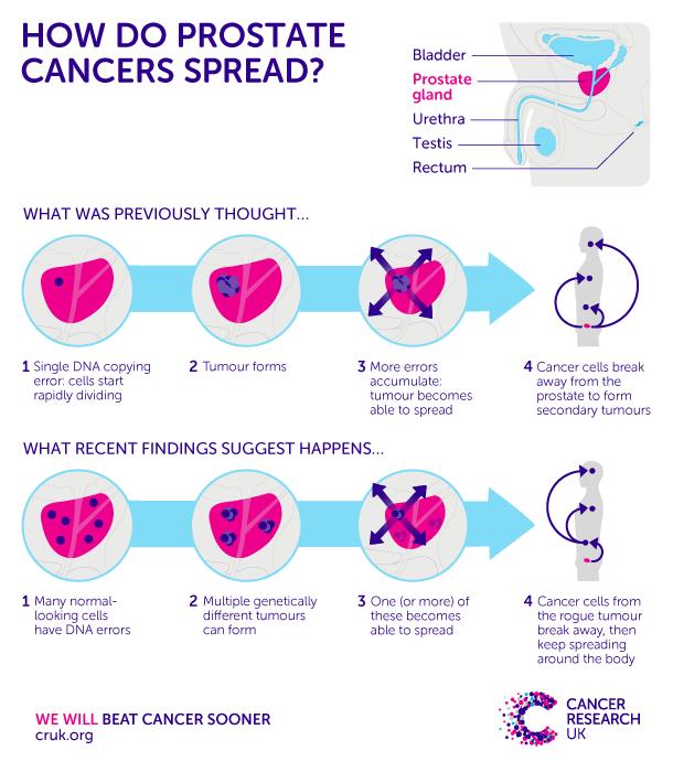 Can Prostate Cancer Spread To Your Spine