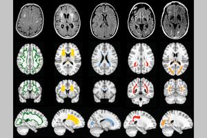 White matter damage patterns in the brain