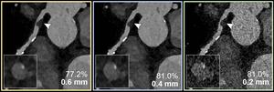 Coronary CT Angiography