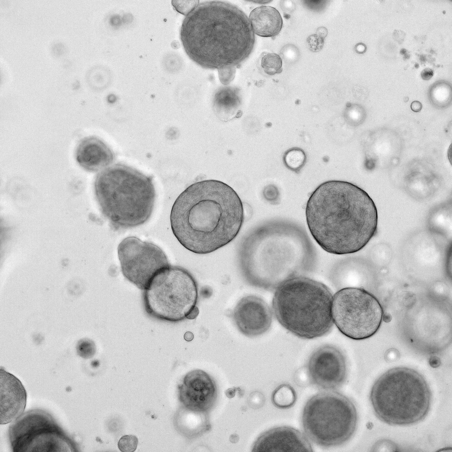Patient-Derived Organoids Help Predict How Patients Respond to Chemotherapy (1 of 5)