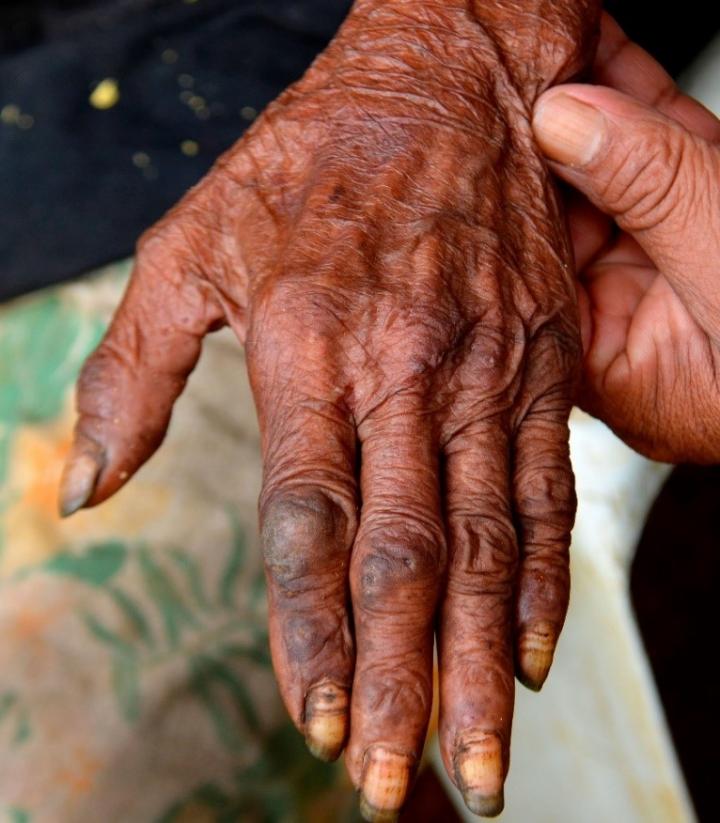 What Happens When Sand Fleas Burrow in Your Skin?