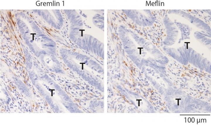 Colon cancer tissue