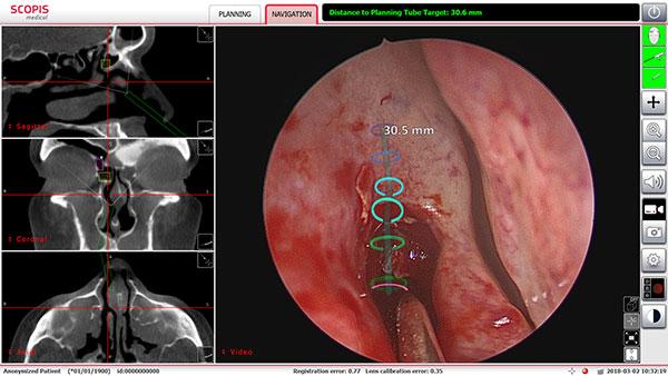 Augmented Reality Technology in Minimally Invasive Sinus Surgeries