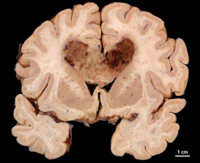 Glioblastoma