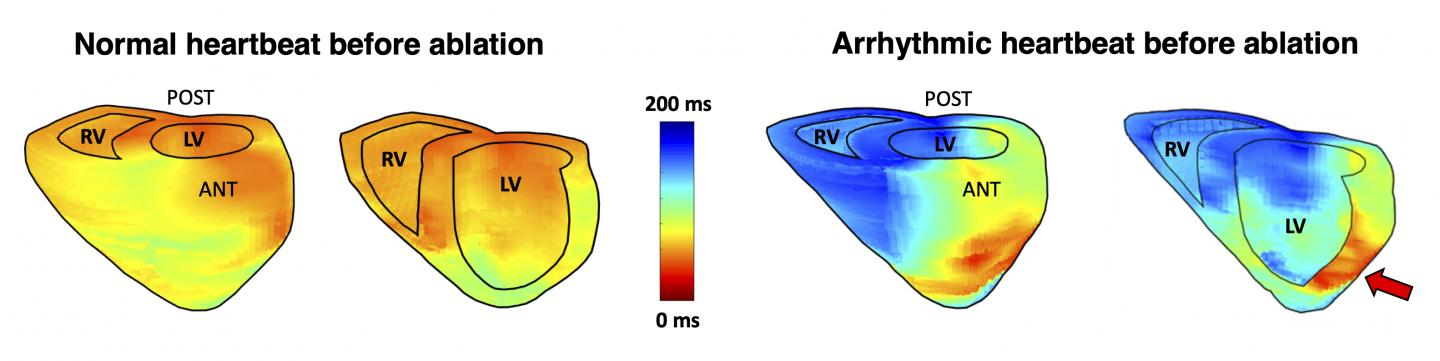 Electromechanical Wave Imaging (EWI) Activation Maps