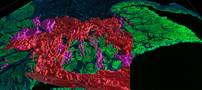 3D reconstruction of colorectal cancer