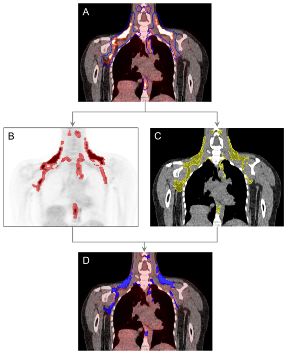 Active brown adipose tissue protects against | EurekAlert!