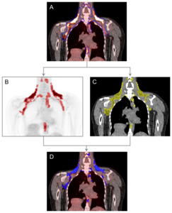 Detection and segmentation of BAT on FDG PET