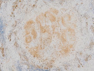 Tuberculosis Bacterium May Undermine Immune Regulation to Drive Disease Progression