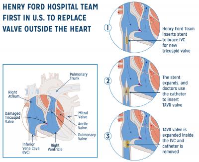 Henry Ford Hospital Replaces Heart Valve Outside the Heart (1 of 3)