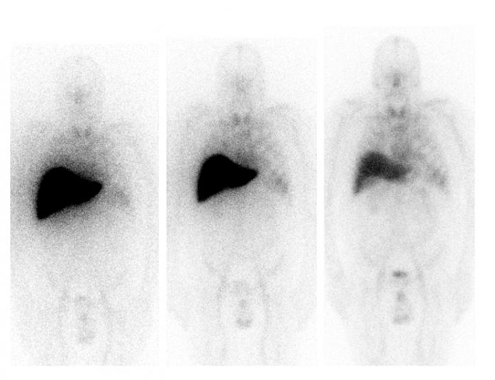 Combination Treatment for Rare Disease Safely Clears Protein Deposits in Vital Organs (1 of 2)