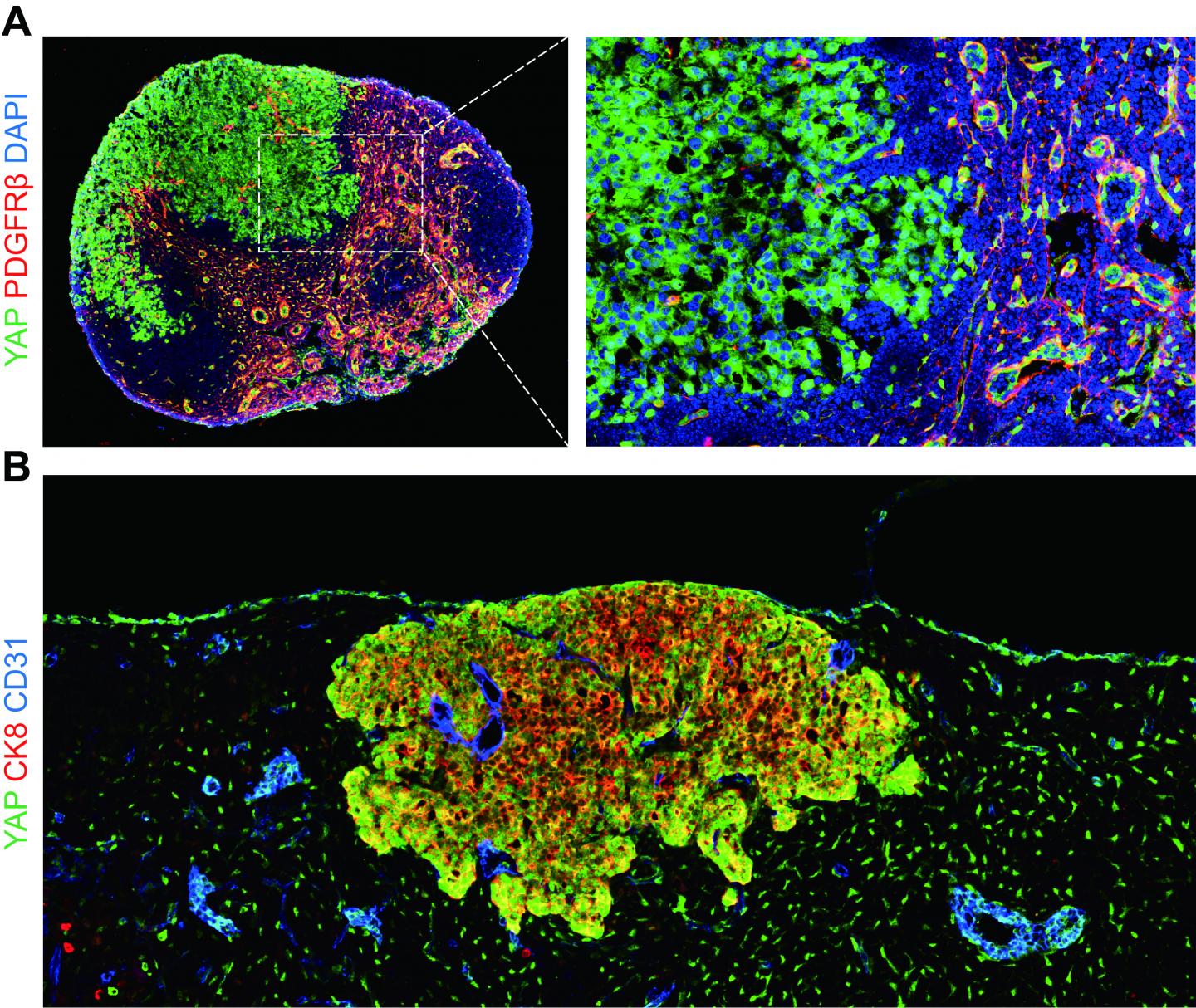 how-do-metastatic-tumor-cells-grow-in-lymph-n-eurekalert