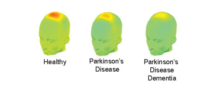 EEG predicts Parkinson's dementia