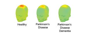 EEG predicts Parkinson's dementia