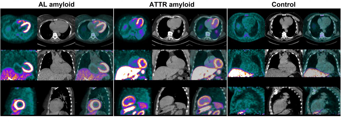 Heart PET Scan