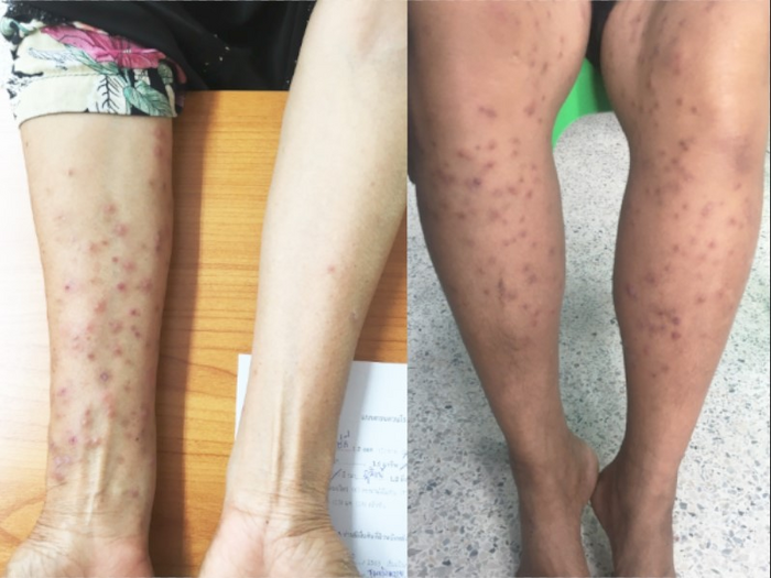 Cercarial dermatitis cases from Chana district, October 2020