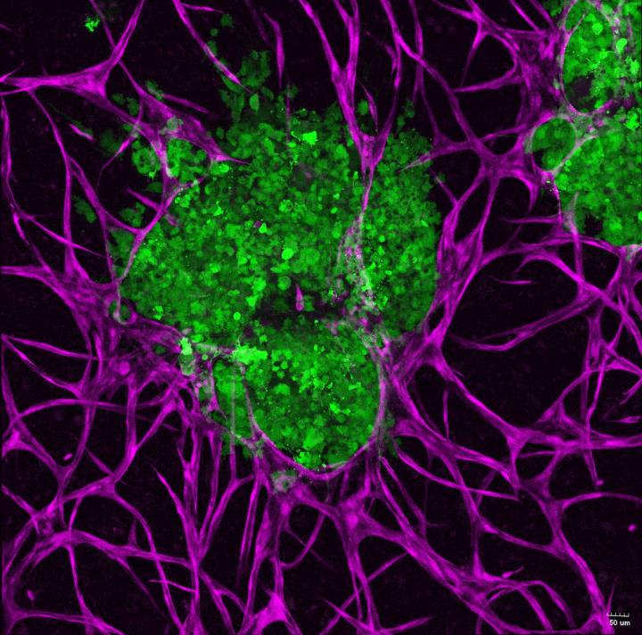 cancer cell surrounded