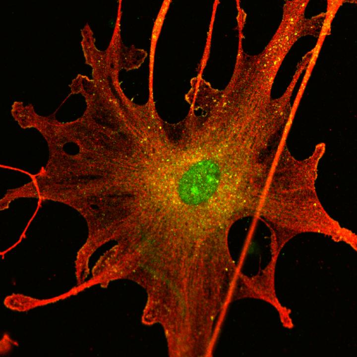 Schwannoma Tumor Cell