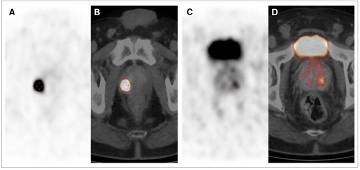 68Ga-PSMA PET/CT Images Showing Multifocal PCA in Peripheral Zone with GS of 5 1 5 5 10