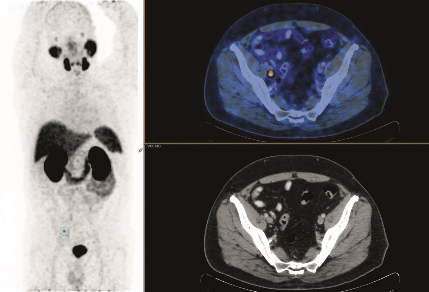 PSMA PET/CT Before-and-after Salvage Radiotherapy