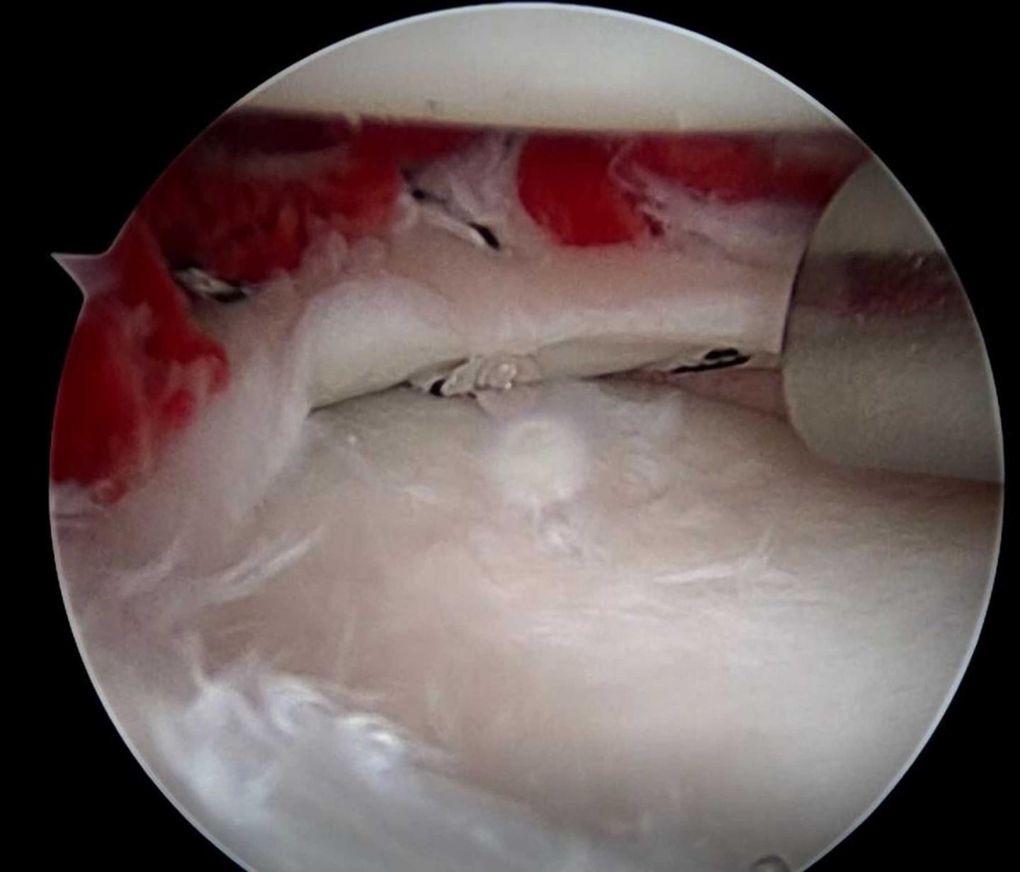 Red on white: fibrin clot on the repaired meniscus