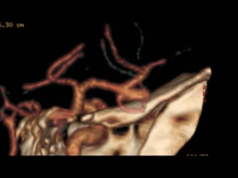 Microneurosurgical Clipping of an Unruptured Intracranial Aneurysm