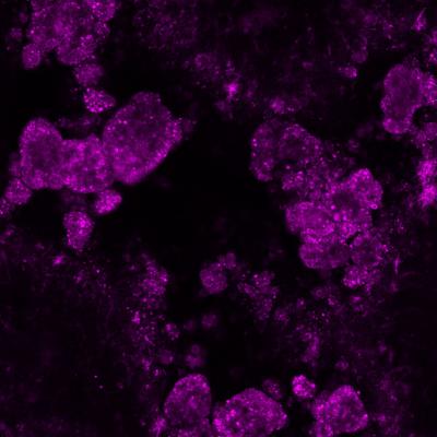 Calcium-Based Deposits in the Eye