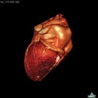 3-D Image of Heart and Scar Tissue