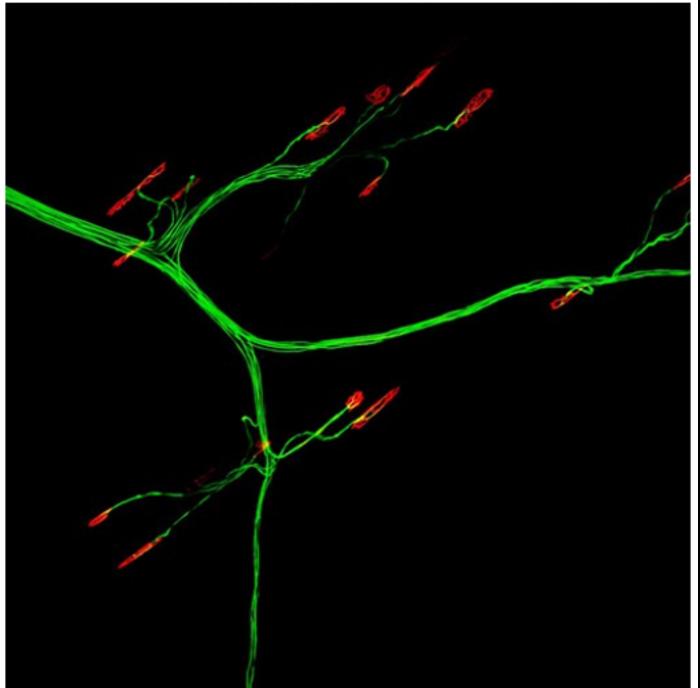 Exploring the association between Guillain–Barré syndrome (GBS) and Takotsubo cardiomyopathy (TCM)