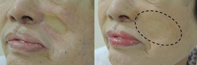 Cosmetically Smoothing Over Visible Facial Scars