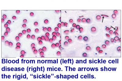 Normal vs. Sickle Cell Blood Cells