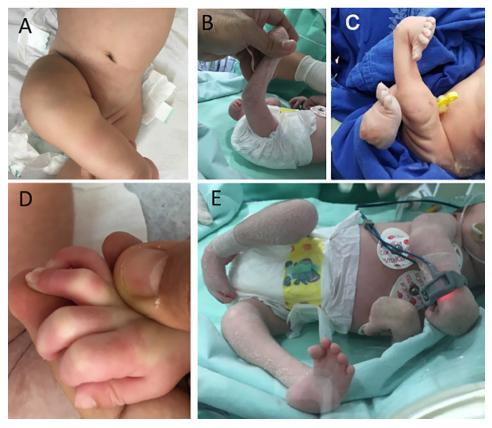 Clinical Pictures of Children with Arthrogryposis