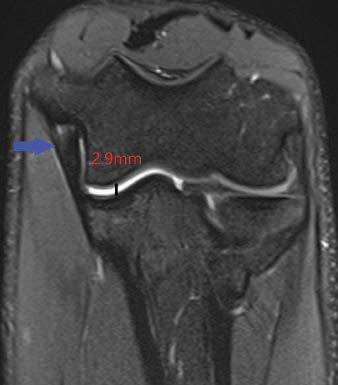 Coronal Fat-Saturated Proton-Density Weighted MR Image in FEVER View