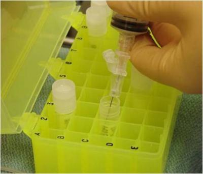 Ocular Melanoma Test