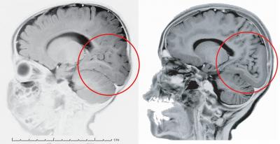 How a Brain Gets Folds