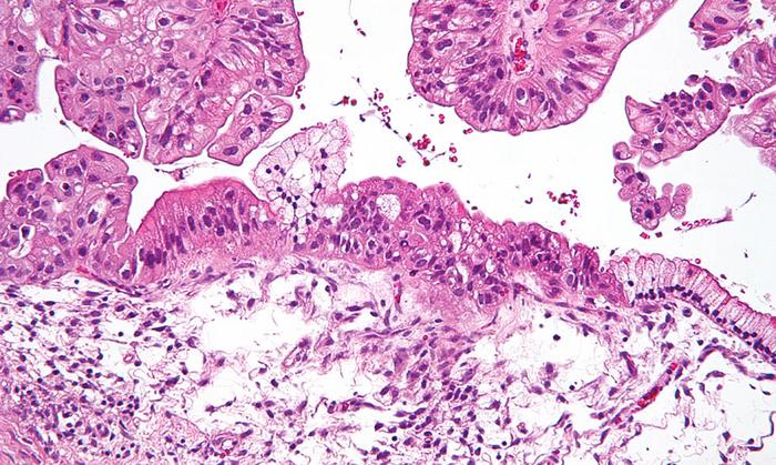 Micrograph of a mucinous ovarian tumor (NIH)
