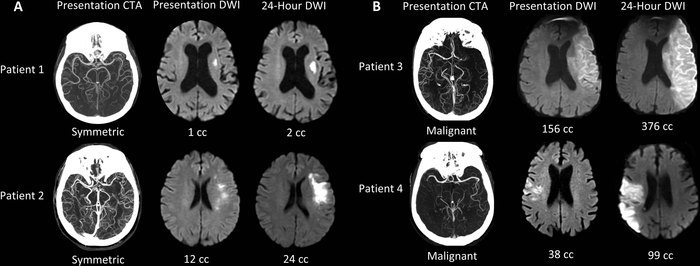Imaging Speeds Lifesaving Care to Stroke Victims