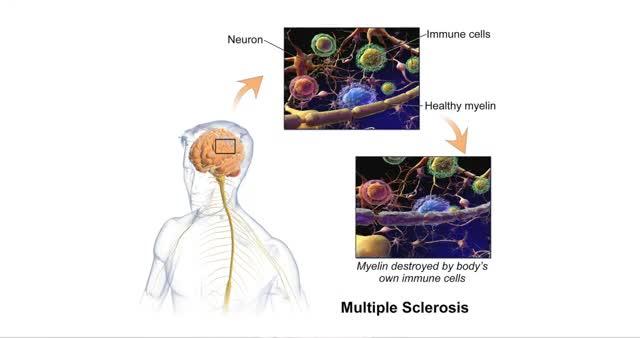 Can a New Immune System Halt Ms and Allow Repair?