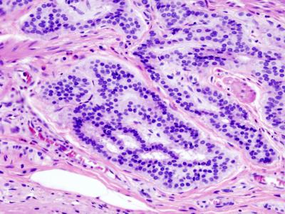 Histopathologic Image of a Colonic Carcinoid Stained by Hematoxylin and Eosin